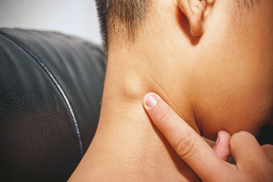 Swollen Lymph Nodes (Lymphadenopathy/Adenopathy): Symptoms & Causes